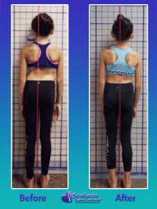 scoliosis exercises before and after