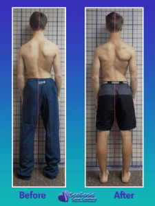 Fixing crooked back posture from scoliosis