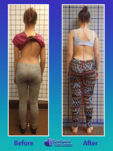 Severe scoliosis treatment posture results