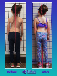 Adolescent Idiopathic scoliosis treatment results