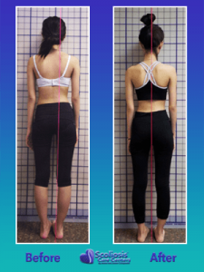 Scoliosis posture transformation