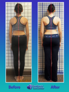 Scoliosis before and after upright posture improvment