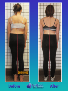 Nonsurgical scoliosis treatment posture results