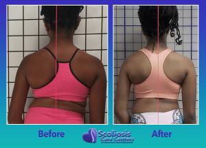 Dramatic Posture improvement from nonsurgical scoliosis treatment