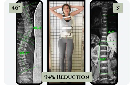 Silicon Valley Brace comparison for scoliosis correction