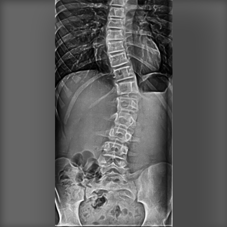 Early Scoliosis Diagnosis with Xray