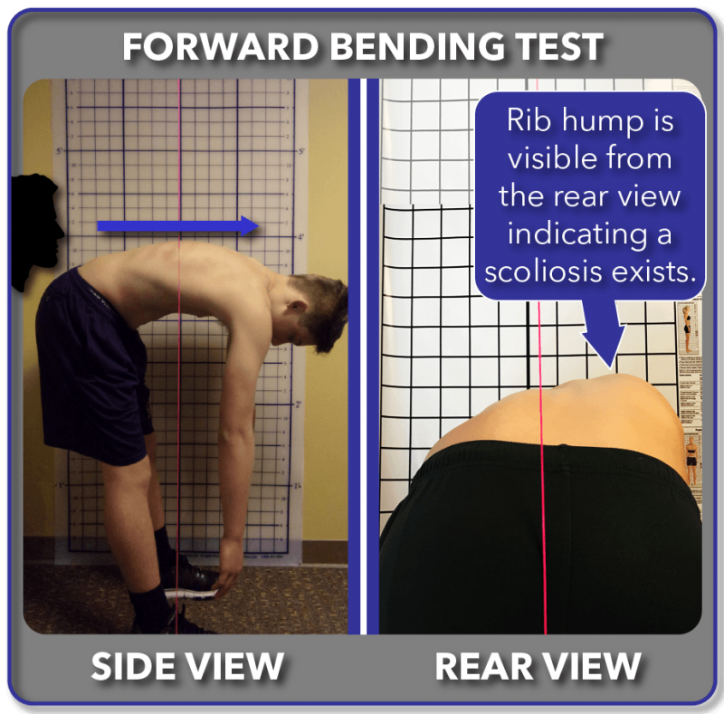 Scoliosis MRI Screening Radiation Free Scoliosis Care Centers