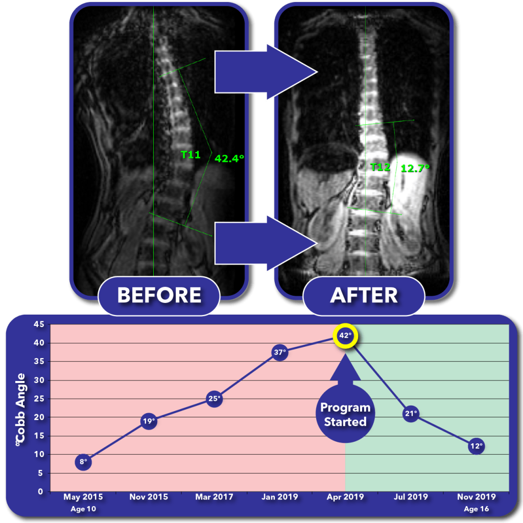 Curve Correction Program For Children & Teens - Scoliosis Care Centers