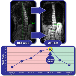 Before and after MRI images with progress graph for curve correction program