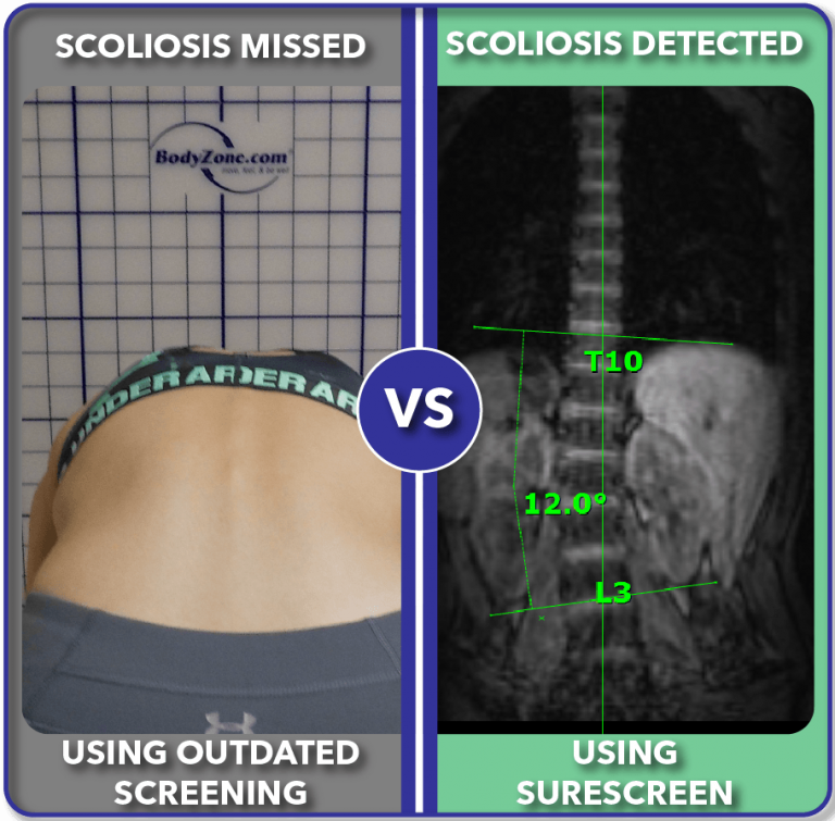 Scoliosis MRI Screening Radiation Free Scoliosis Care Centers