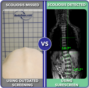 Before and after improved scoliosis screening with SureScreen 17 degree curve