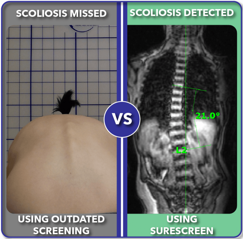 scoliosis-mri-screening-radiation-free-scoliosis-care-centers