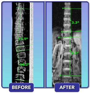 Before and after scoliosis treatment for 17 degree curve