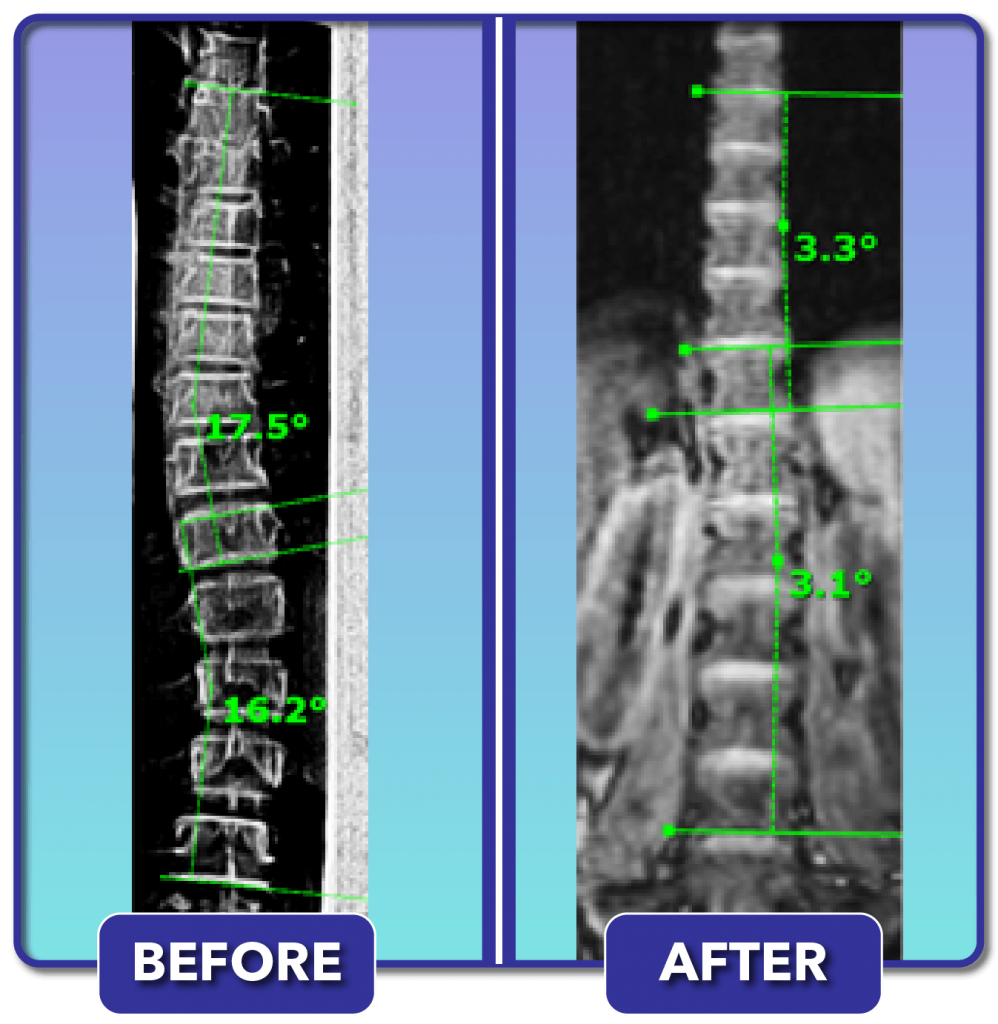 Scoliosis Before and After Treatment Results Scoliosis Care Centers