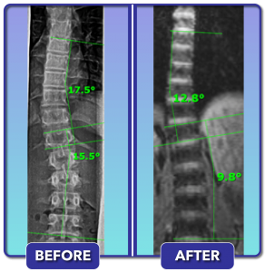 Before and after scoliosis treatment for 18 degree curve