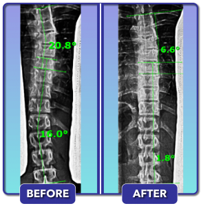 Before and after scoliosis treatment for 21 degree curve