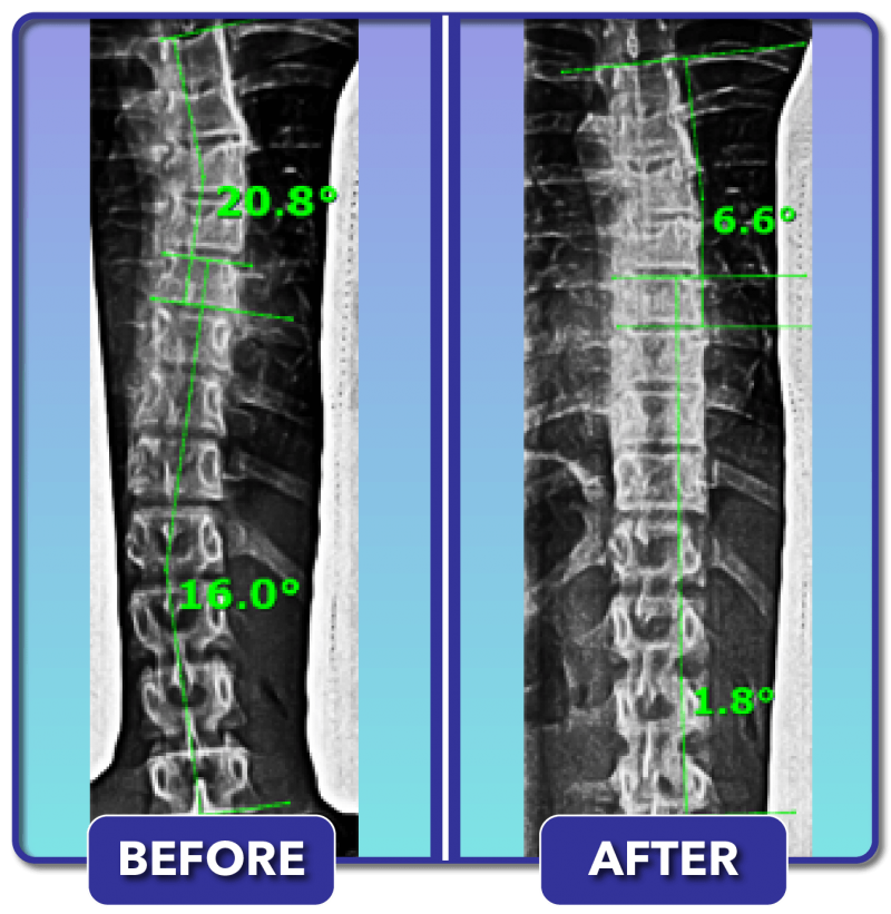 Scoliosis Before and After Treatment Results Scoliosis Care Centers