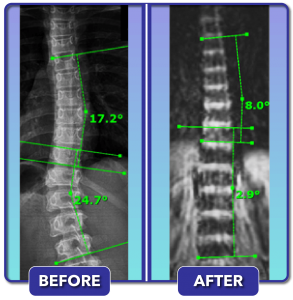 Before and after scoliosis treatment for 25 degree curve