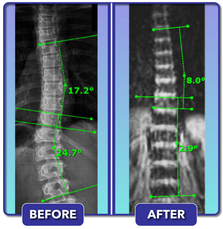 Scoliosis Before and After Treatment Results Scoliosis Care Centers