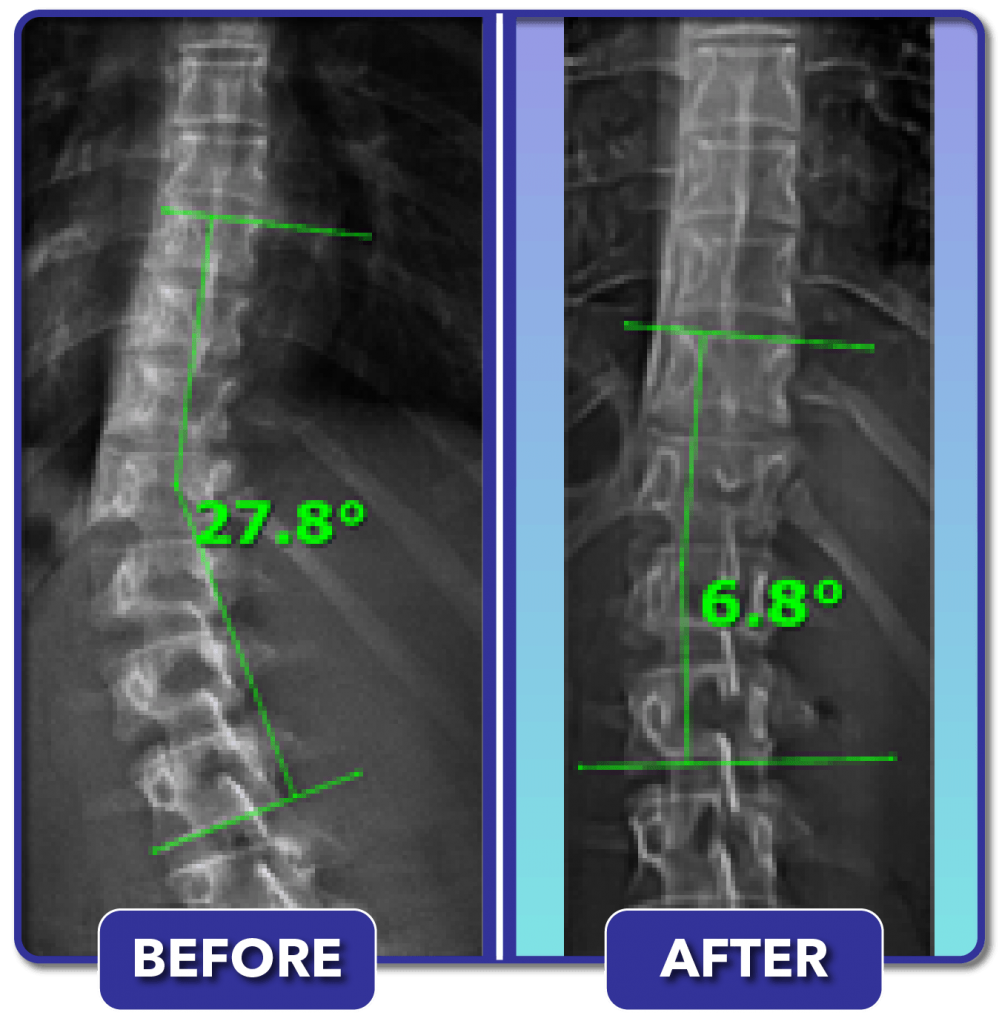 Scoliosis Before And After Treatment Results - Scoliosis Care Centers