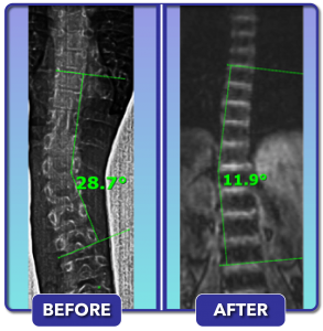 Before and after scoliosis treatment for 29 degree curve
