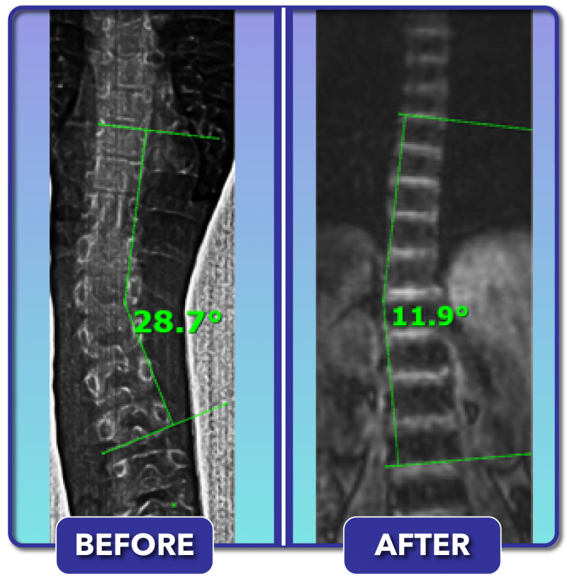 Scoliosis Before and After Treatment Results Scoliosis Care Centers