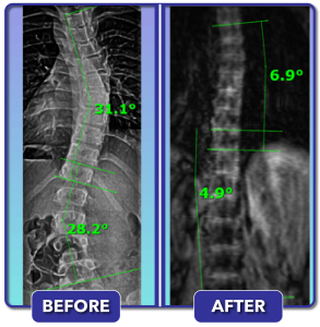 Before and after scoliosis treatment for 31 degree curve