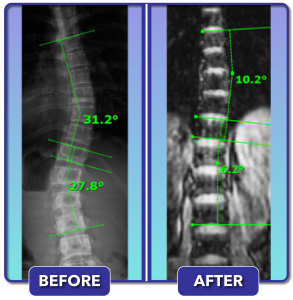 Before and after scoliosis treatment for 31 degree curve