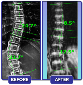 Before and after scoliosis treatment for 33 degree curve