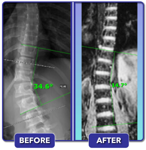Before and after scoliosis treatment for 35 degree curve