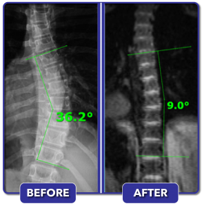 Before and after scoliosis treatment for 36 degree curve
