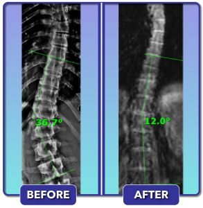 Before and after scoliosis treatment for 37 degree curve