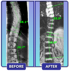 Before and after scoliosis treatment for 38 degree curve