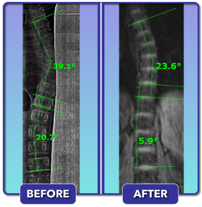 Before and after scoliosis treatment for 39 degree curve