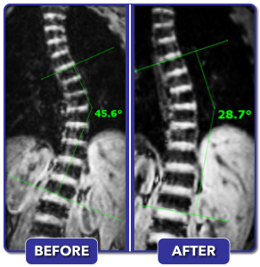 Before and after scoliosis treatment for 45 degree curve