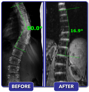 Before and after scoliosis treatment for 50 degree curve