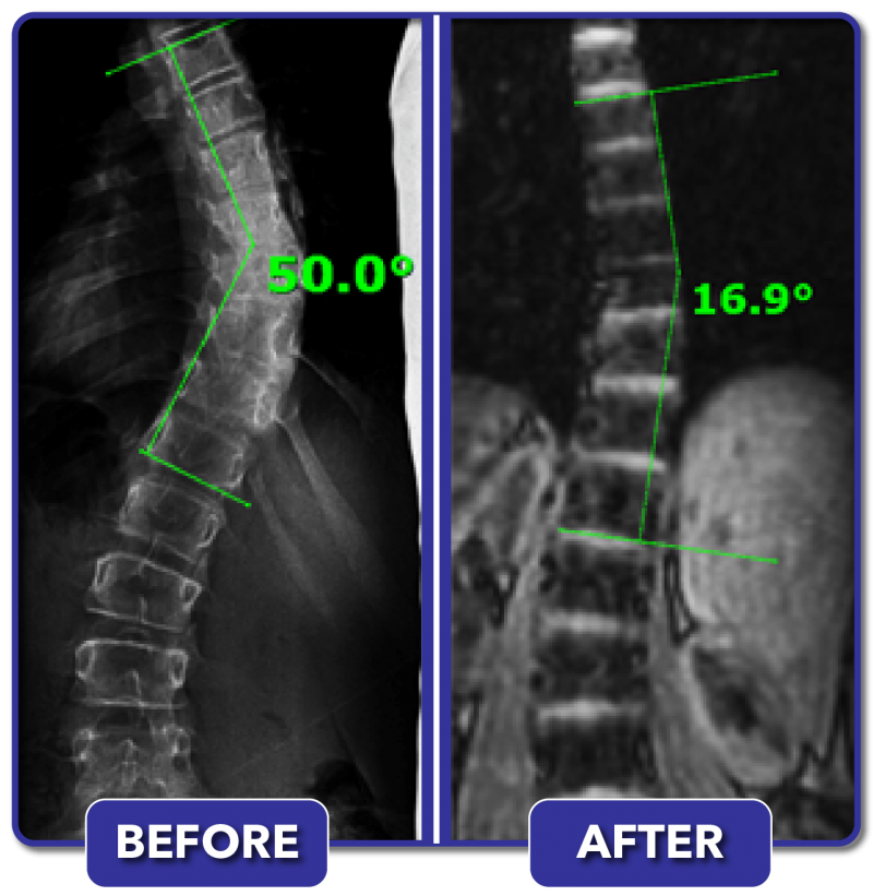 Scoliosis Before And After Treatment Results - Scoliosis Care Centers