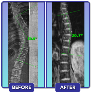 Before and after scoliosis treatment for 50 degree curve