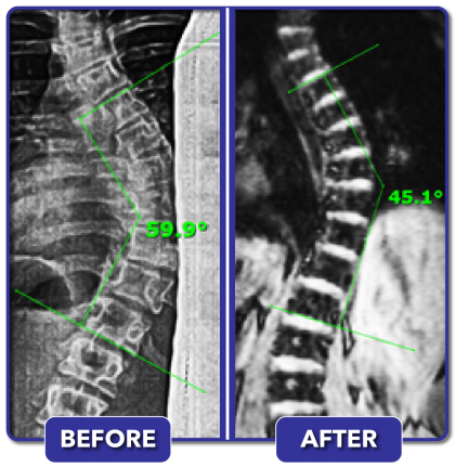 Scoliosis Before and After Treatment Results - Scoliosis Care Centers