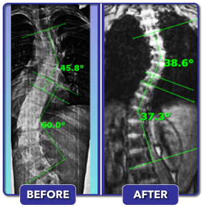 Before and after scoliosis treatment for 60 degree curve