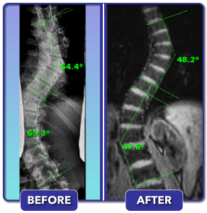 Before and after scoliosis treatment for 65 degree curve