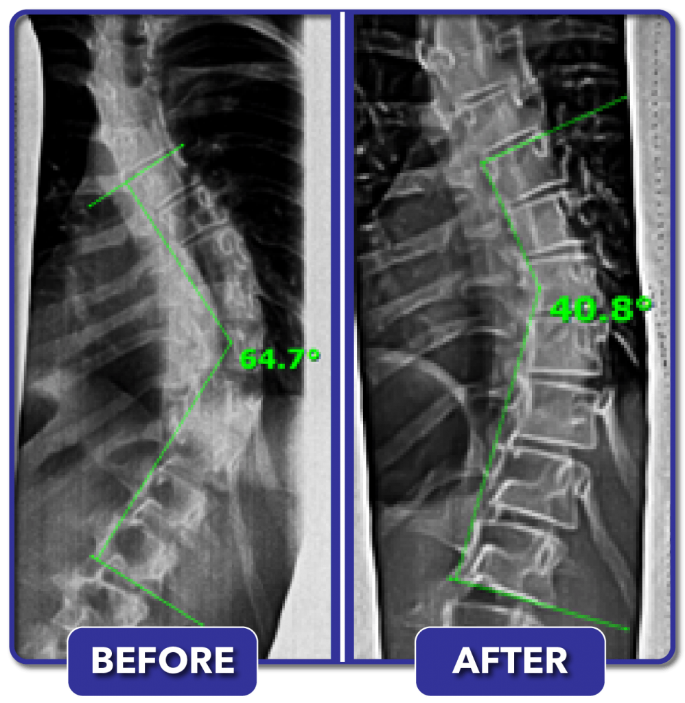 Scoliosis Before And After Treatment Results Scoliosis Care Centers 0893