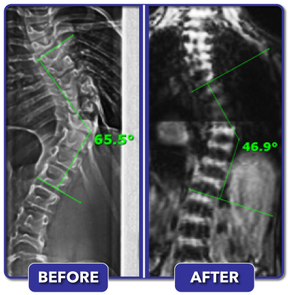 Scoliosis Before and After Treatment Results - Scoliosis Care Centers