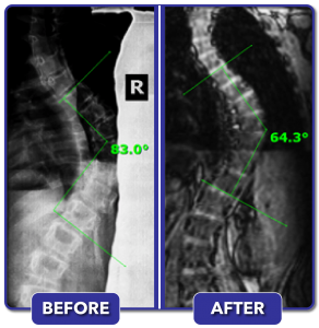 Before and after scoliosis treatment for 83 degree curve