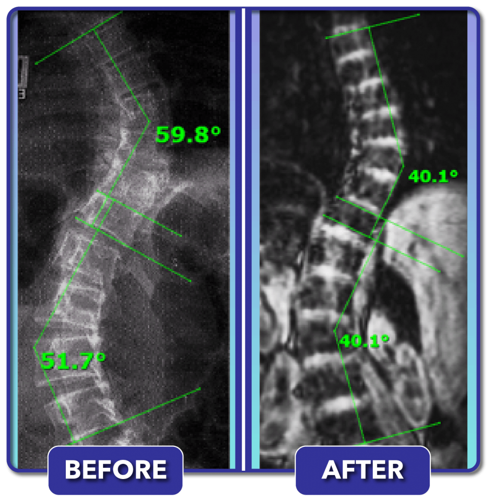 Scoliosis Before and After Treatment Results Scoliosis Care Centers