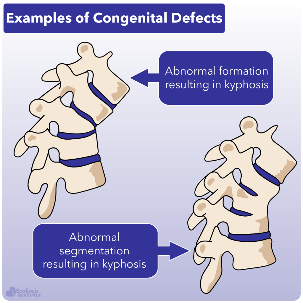 kyphosis-and-hyperkyphosis-what-it-is-how-it-happens-and-what-to-do