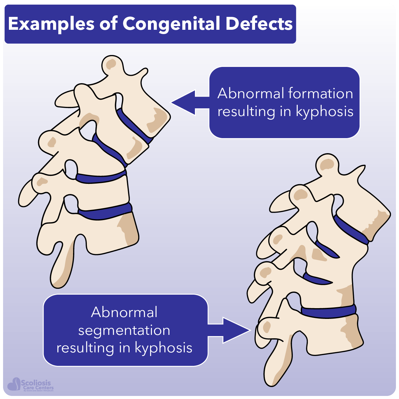 congenital defects causing kyphosis 8
