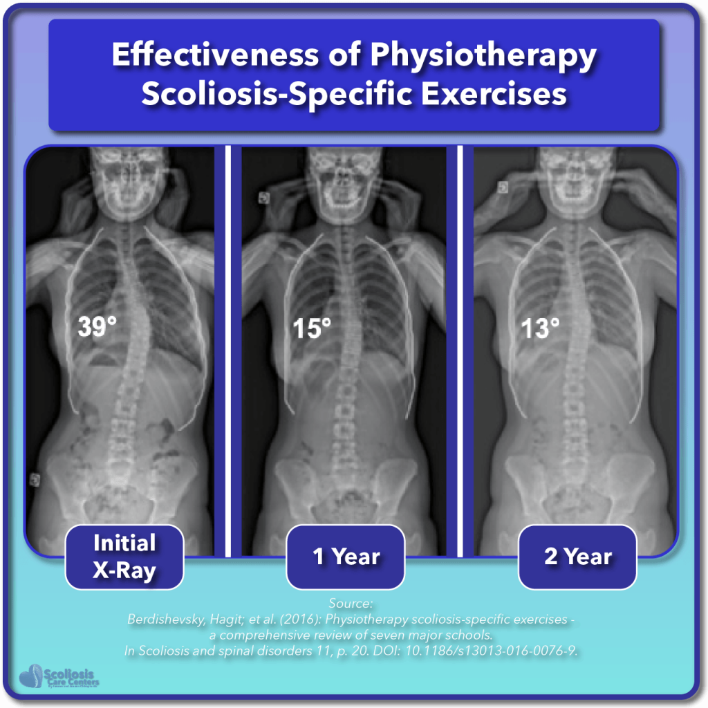 Scoliosis Degrees Of Curvature Chart