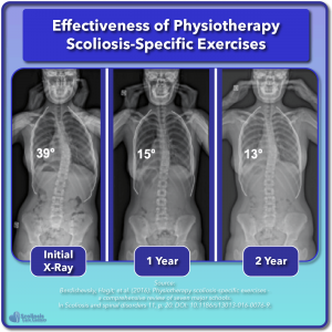 Effectiveness of physiotherapy scoliosis specific exercises