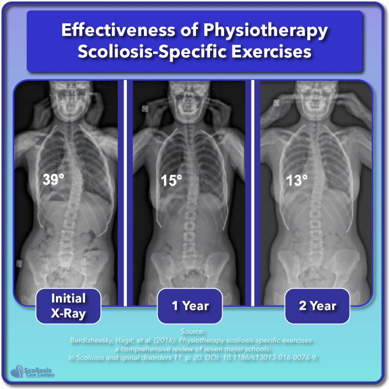 Scoliosis Treatment For Children And Teens - Scoliosis Care Centers